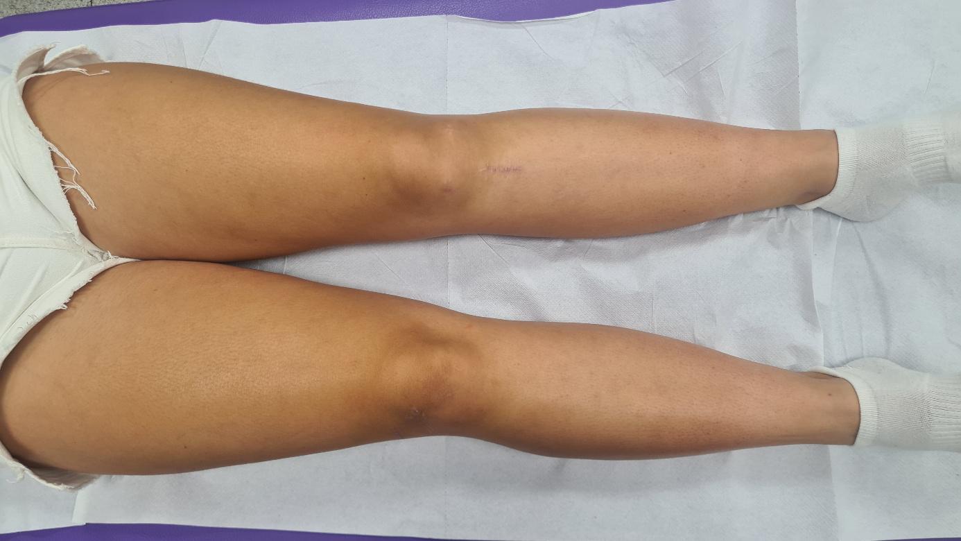 Prednji križni ligament (ACL)