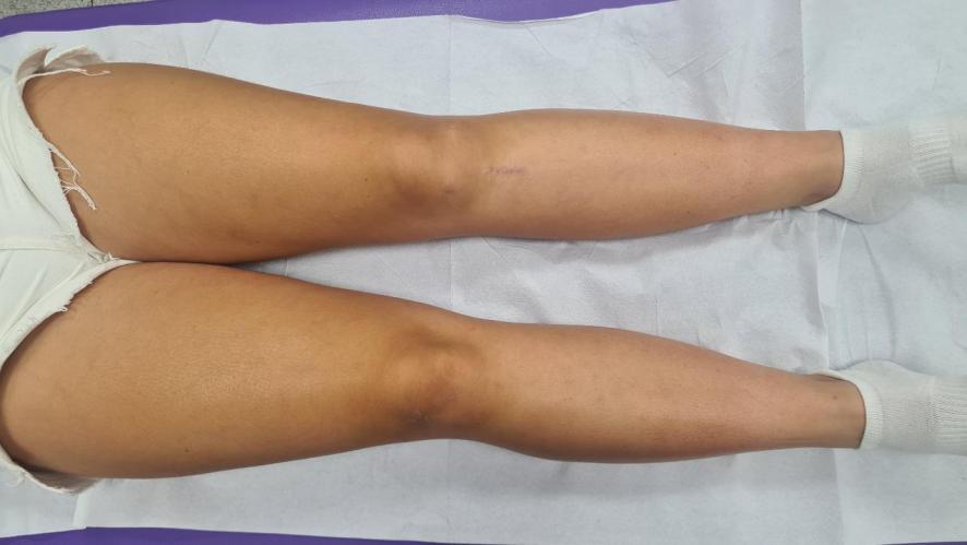 Operacija koljena, rekonstrukcija prednjeg križnog ligamenta