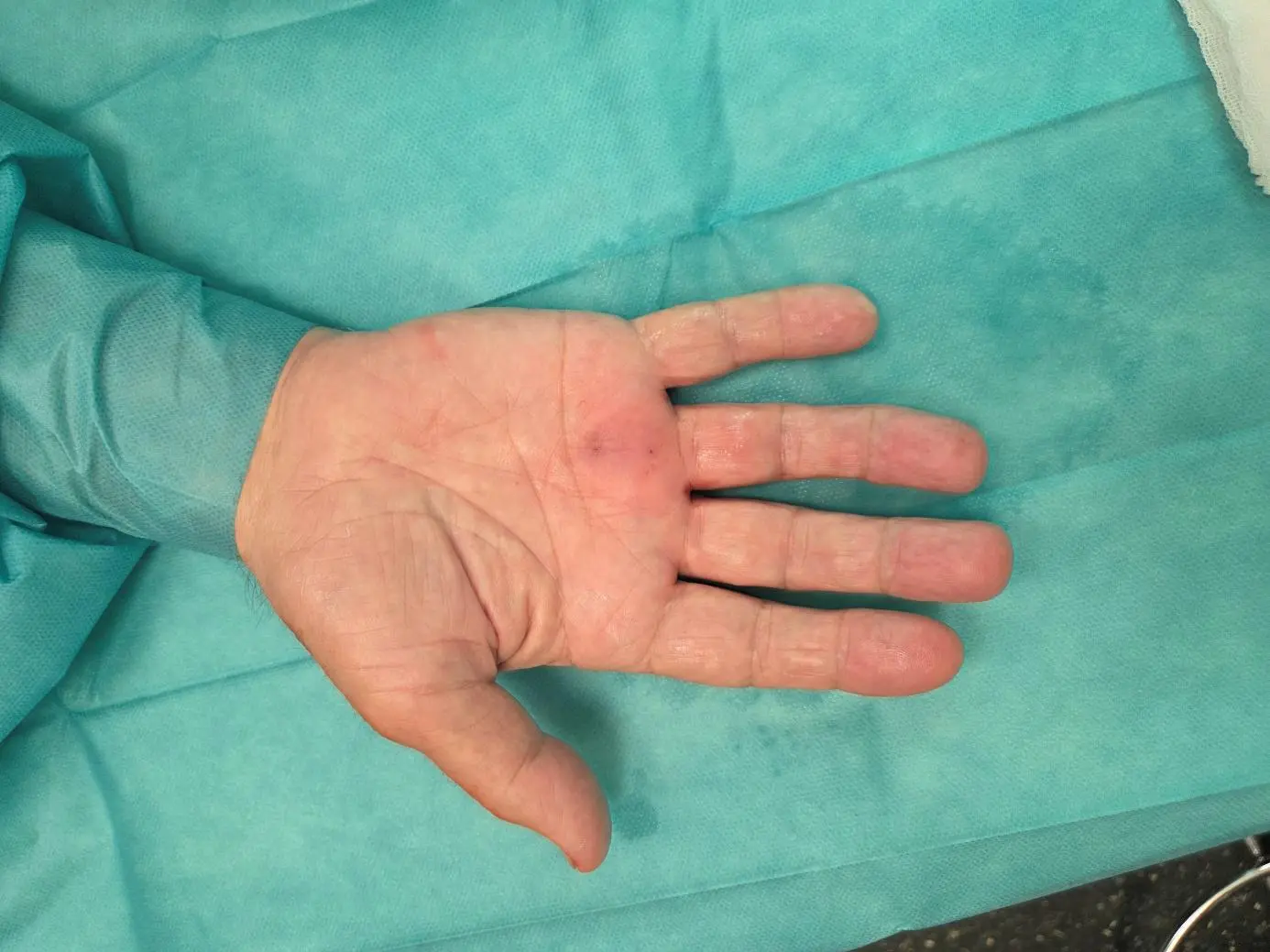 Trigger finger